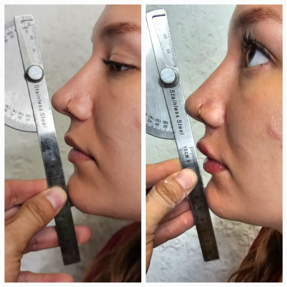 Antes y despues de aplicacion de acido hialuronico con medicion de perfil.