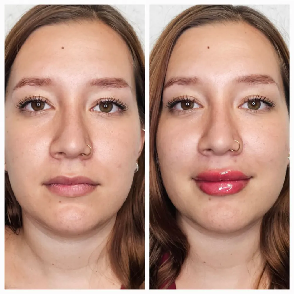 Resultado de relleno de labios en medicina estética.
